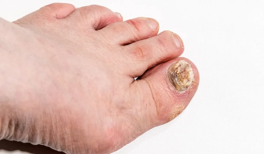 Image of a foot with a fungal infection at the base of the nail. Kerassentials.